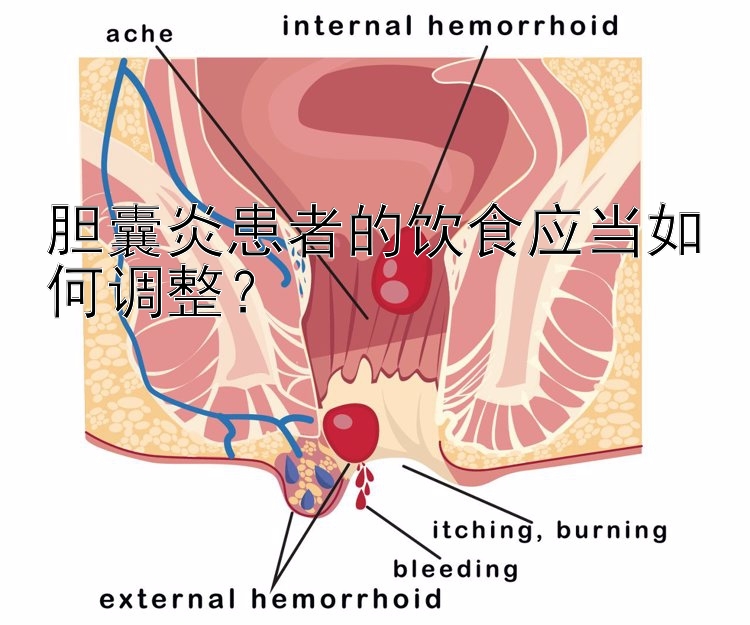 胆囊炎患者的饮食应当如何调整？